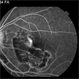 Macular Serpiginous Choroidopathy Macular Serpiginous Choroidopathy